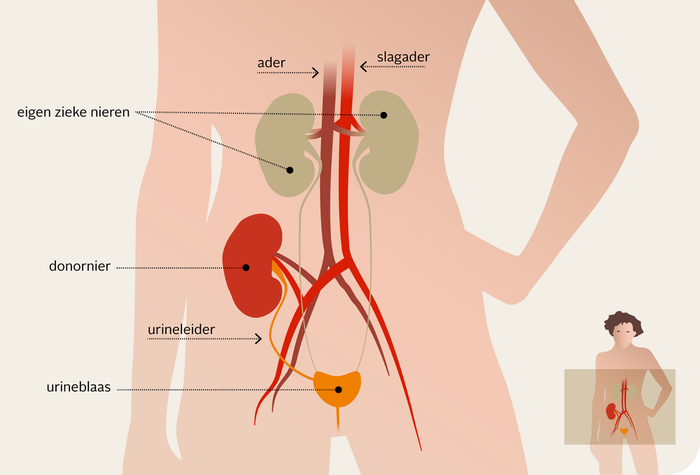 Illustratie van organen in lichaam en transplantatienier